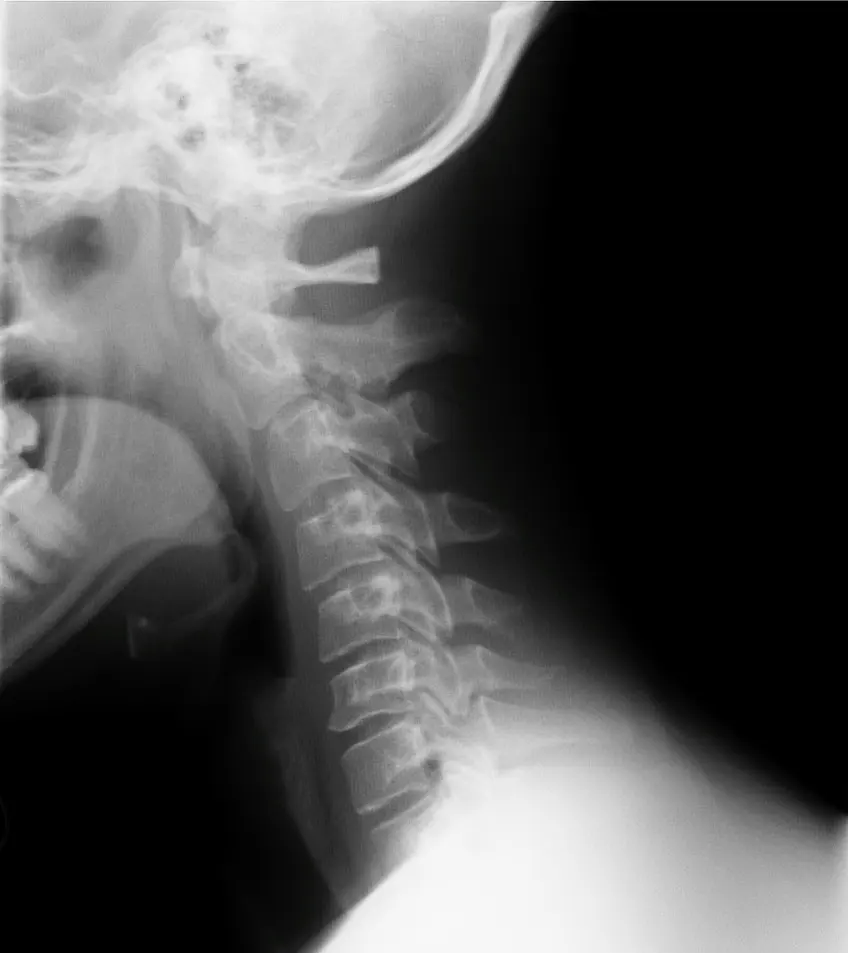 rediografia cervical 